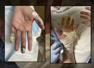 What’s medical tourism: Girl warns others after ‘completely disfigured’ by beauty surgical procedure process in Mexico